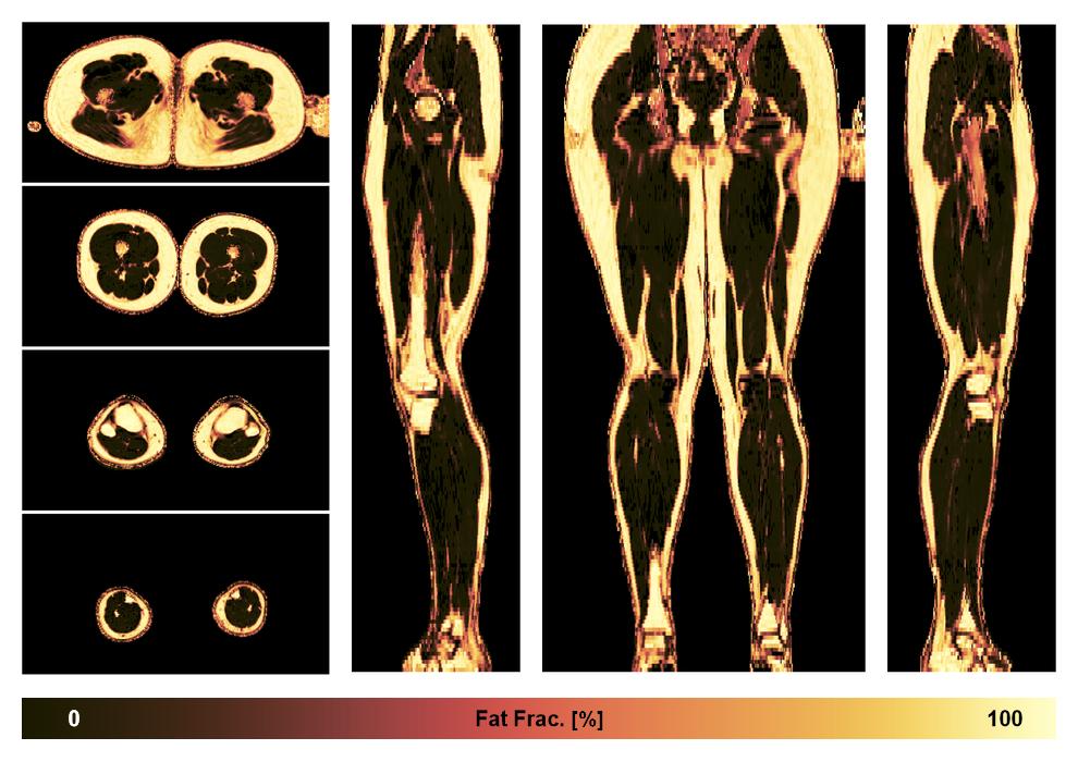 The fat fraction of the lower extremity obtained from the dixon reconstruction for muscle water fat quantification.